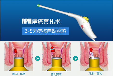 RPH微创术为患者保留最多的正常组织