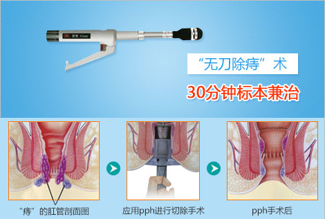 PPH手术的真面目